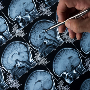 Pacientes con alguna lesión cerebral preexistente tienen riesgo de padecer epilepsia.