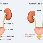 Entidades realizarán chequeo prostático gratuito