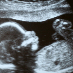 Comprender y prevenir abortos espontáneos mediante análisis de sangre