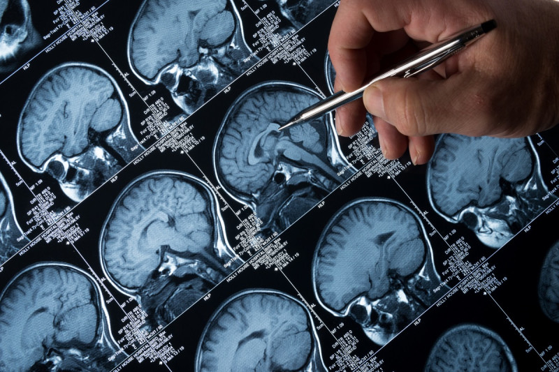 Pacientes con alguna lesión cerebral preexistente tienen riesgo de padecer epilepsia.