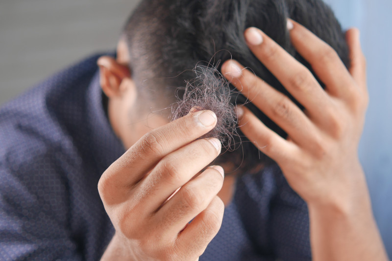 Caída de pelo excesiva, síntoma de alopecia